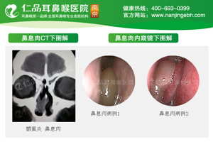 首席医生解读鼻息肉六大症状